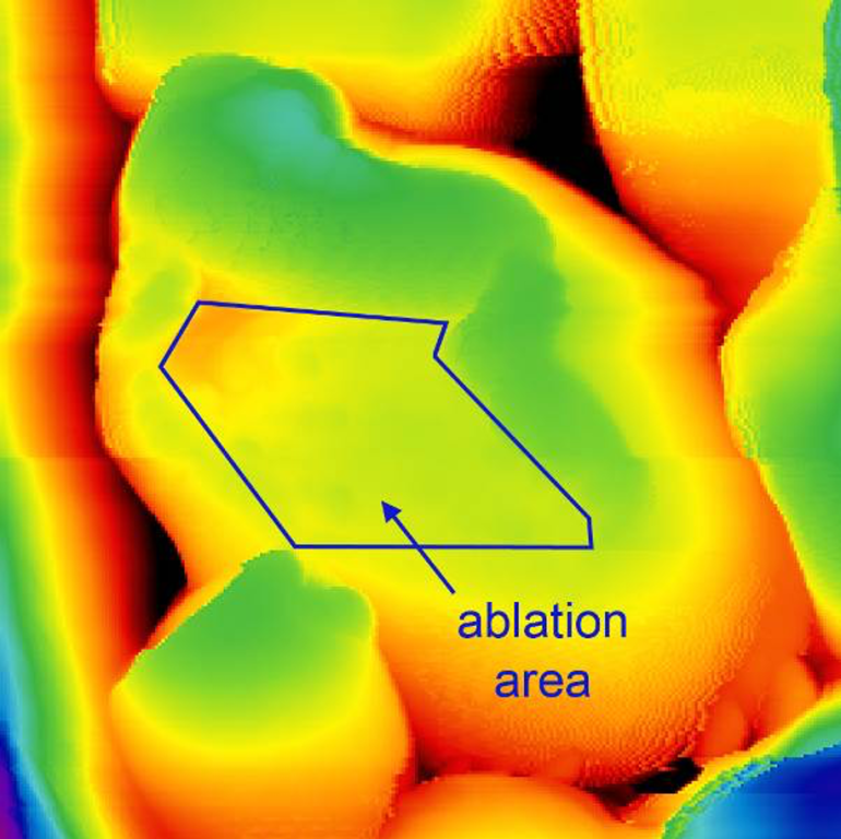 Ablation area