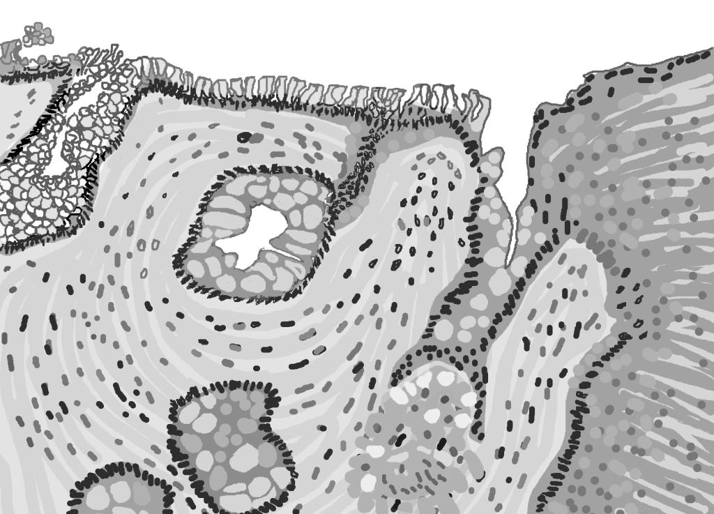A black and white illustration of a microscopic piece of the esophagus shows the abnormal tissue of Barrett’s esophagus. Image: National Institute of Diabetes and Digestive and Kidney Diseases, National Institutes of Health