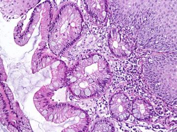 Biopsy from the tubular esophagus showing incomplete intestinal metaplasia, goblet cells with interposed cells having gastric foveolar-type mucin consistent with Barrett esophagus. Negative for dysplasia. H&E stain. Credit: Creative Commons